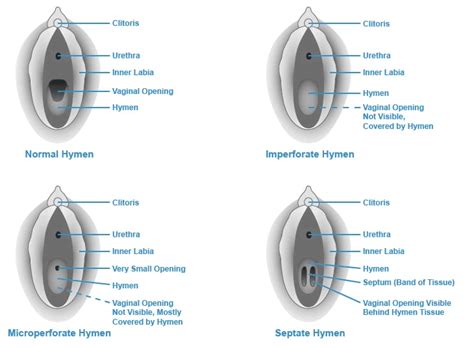 What Is the Hymen: Anatomy, Functions, Types and Care